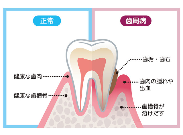 50代からの歯周病対策は予防と治療が肝心！