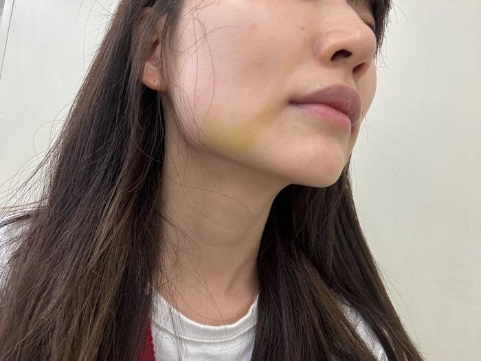 あいのり・桃、美容施術のダウンタイム中の自撮りショットを公開「顎横あたりが黄色くなってます」