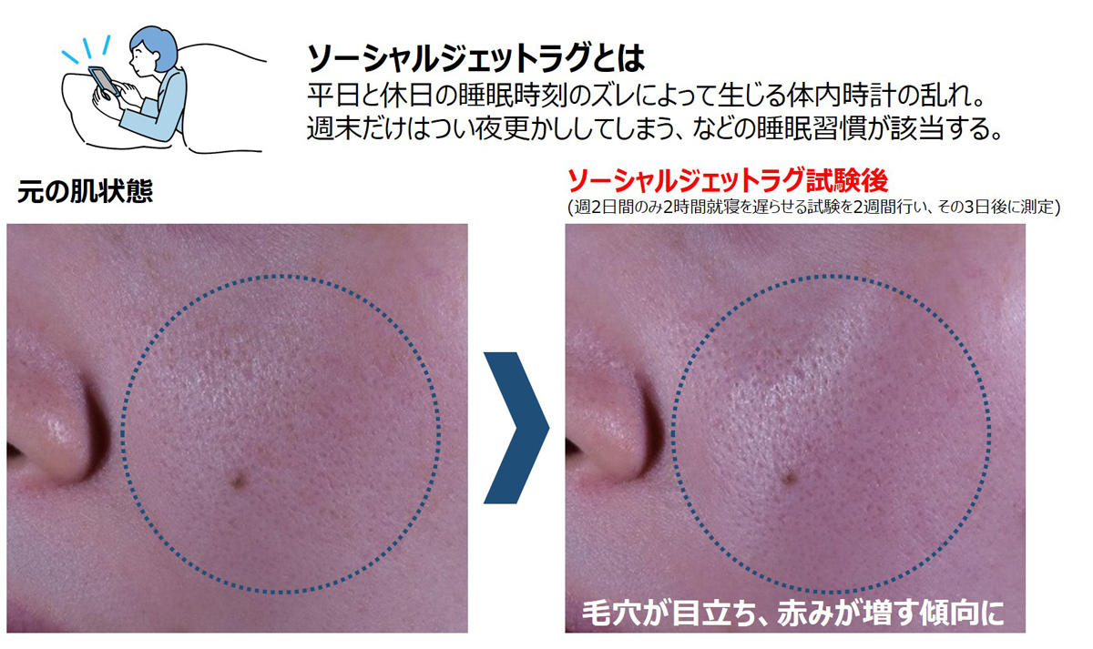 平日と休日の就寝・起床時刻のズレが毛穴の目立ちや顔の赤みを引き起こす、社会的時差ぼけ「ソーシャルジェットラグ」とは? – コーセーの研究