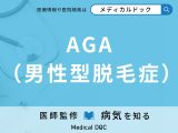 「AGA(男性型脱毛症)」になりやすい人の特徴をご存じですか? 予防法を併せて医師が解説